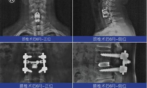 钛合金椎间融合器_椎间盘钛合金价格